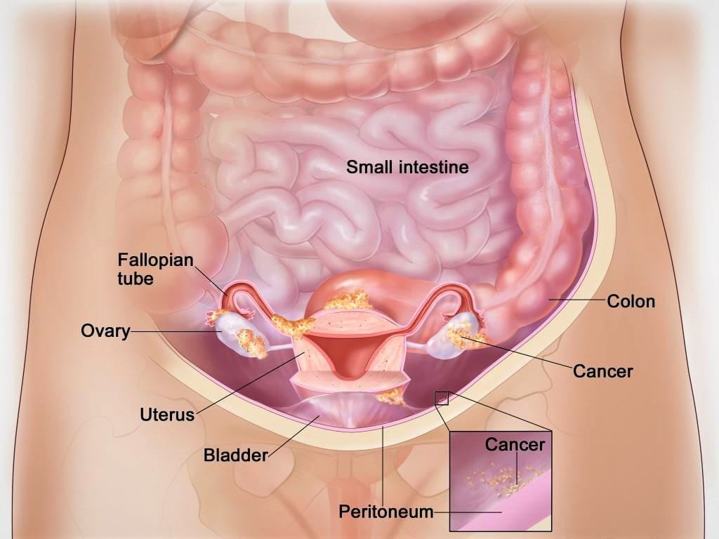 Ovarian cancer endometrial