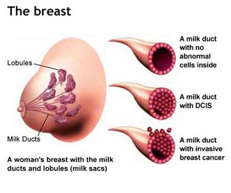 breast cancer gynecologist sobia