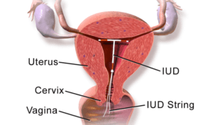 IUD