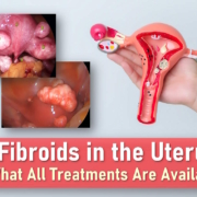 fibroids in uterus, fibroids symptoms, uterine fibroids medication treatment, signs of fibroids breaking down, types of fibroids