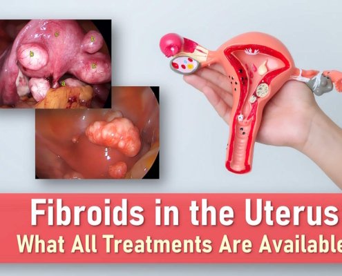fibroids in uterus, fibroids symptoms, uterine fibroids medication treatment, signs of fibroids breaking down, types of fibroids