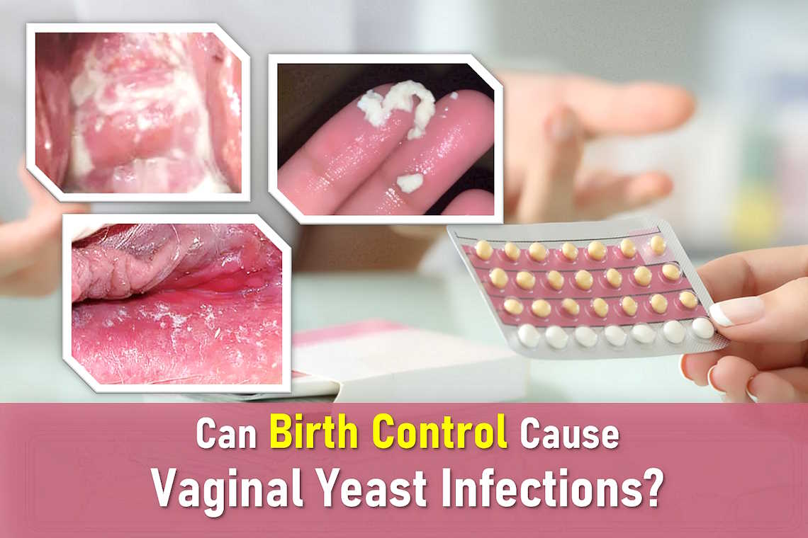 vaginal yeast infection causes women, birth control, yeast infection discharge pictures, birth control side effects