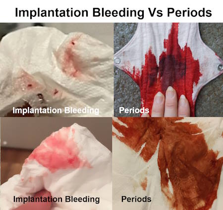 Implantation Bleeding vs. Period, difference, Pictures, colors, Brown pics, implantation bleeding pictures