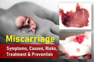 Miscar Miscarriage: Symptoms, Causes, Risks, Treatment & Prevention