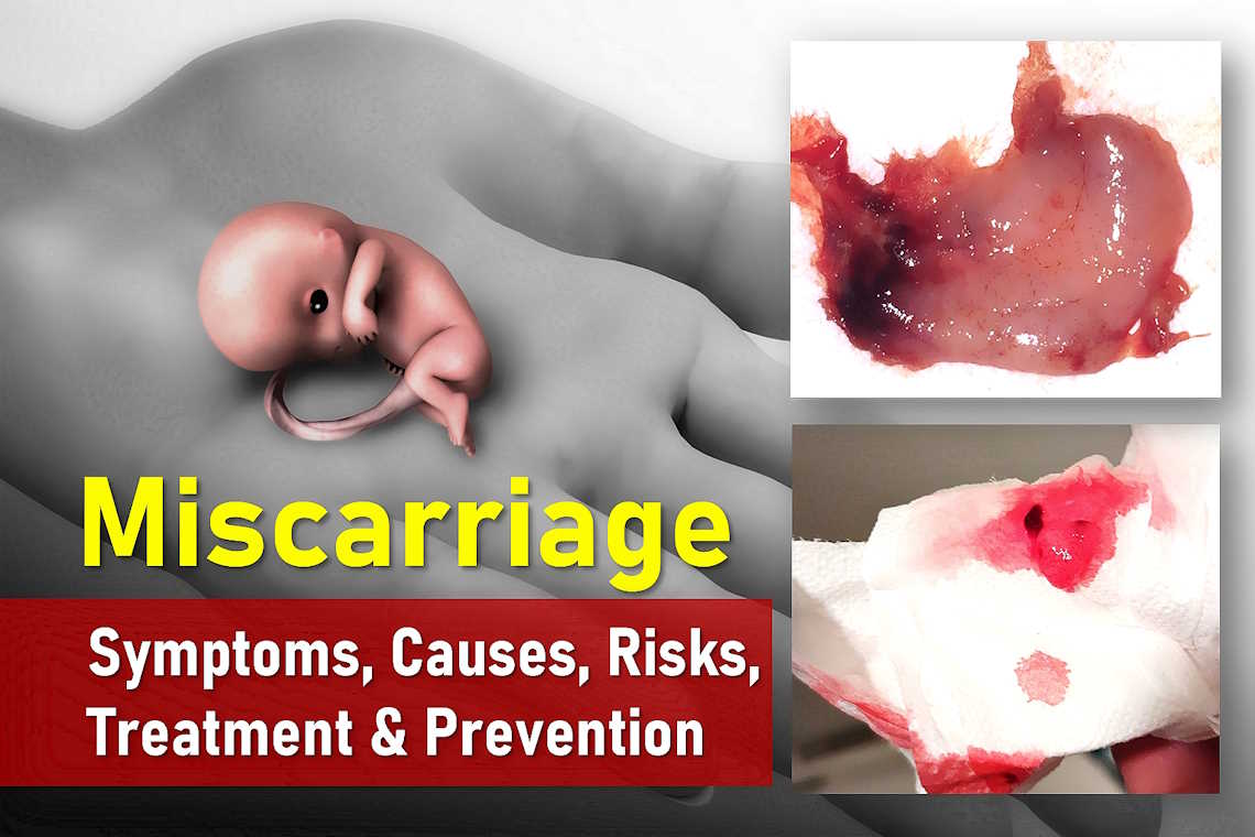 miscarriage symptoms, risk, types, causes, pictures, at 6-14 weeks