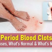 period blood clots pictures, miscarriage golf ball sized blood clots during period