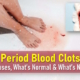 period blood clots pictures, miscarriage golf ball sized blood clots during period