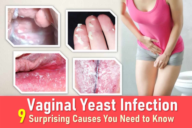 Vaginal Yeast Infection: 9 Surprising Causes You Need to Know