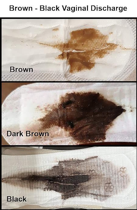 What Does Black Discharge Mean, Black Discharge No Period, after period, before period, 2 Weeks After Period 