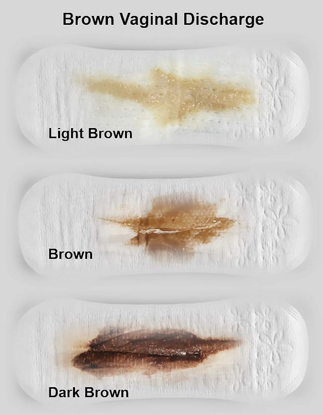 Light brown discharge, Dark brown discharge before after period, spotting causes