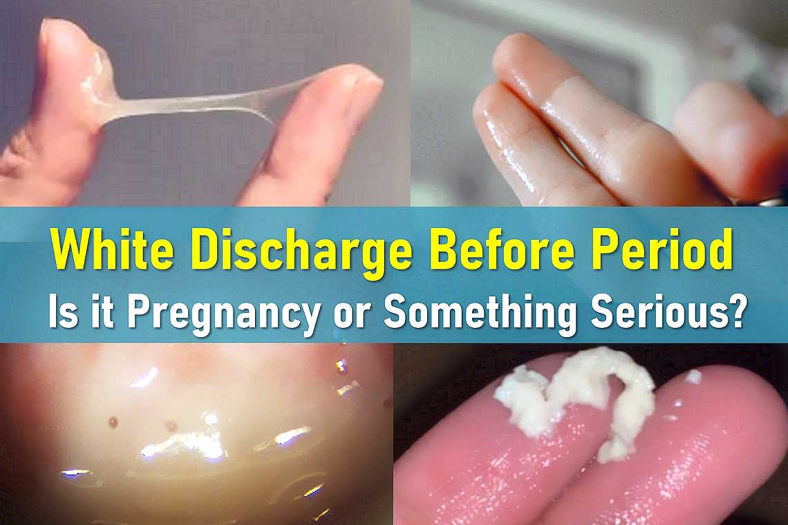 White discharge before period, egg white, thick white, pregnancy, creamy white, milky