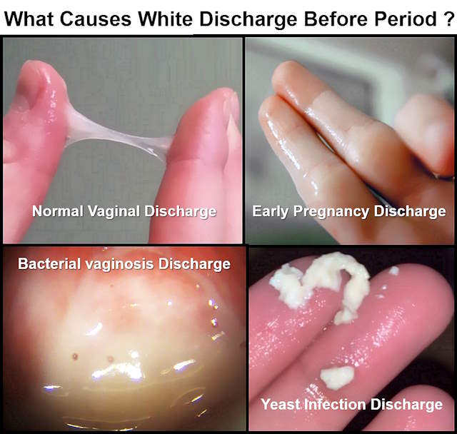 White discharge before period, egg white, thick white, pregnancy, yeast infection, bv, pictures