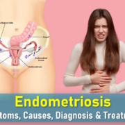 endometriosis symptoms, endometriosis treatments, stage 4 endometriosis life expectancy, endometriosis images