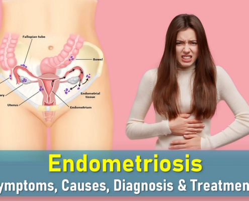 endometriosis symptoms, endometriosis treatments, stage 4 endometriosis life expectancy, endometriosis images