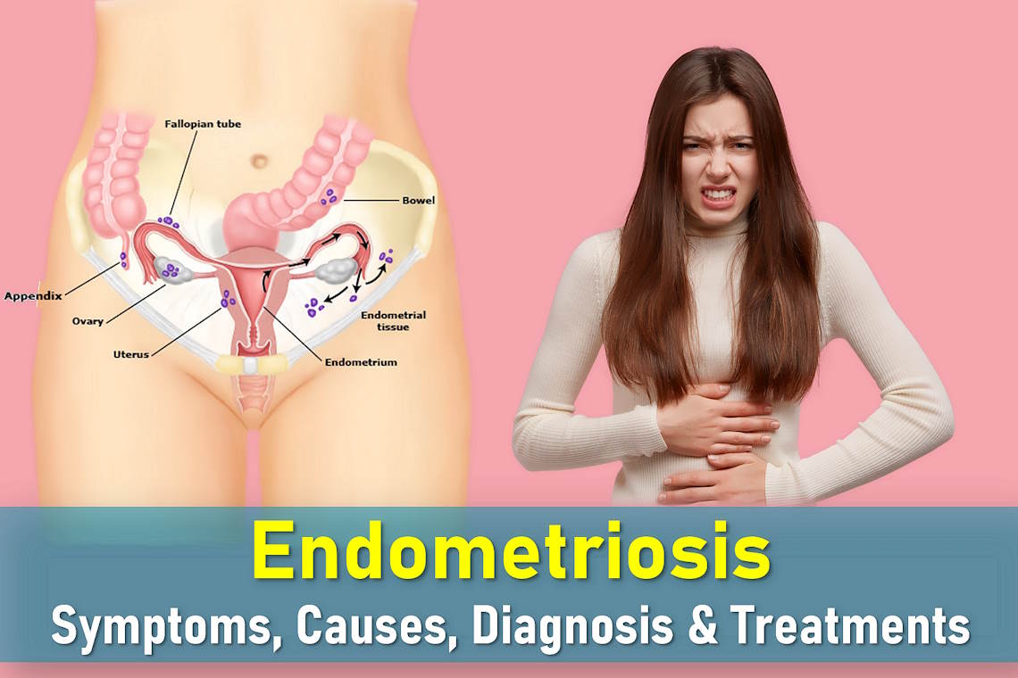 endometriosis symptoms, endometriosis treatments, stage 4 endometriosis life expectancy, endometriosis images