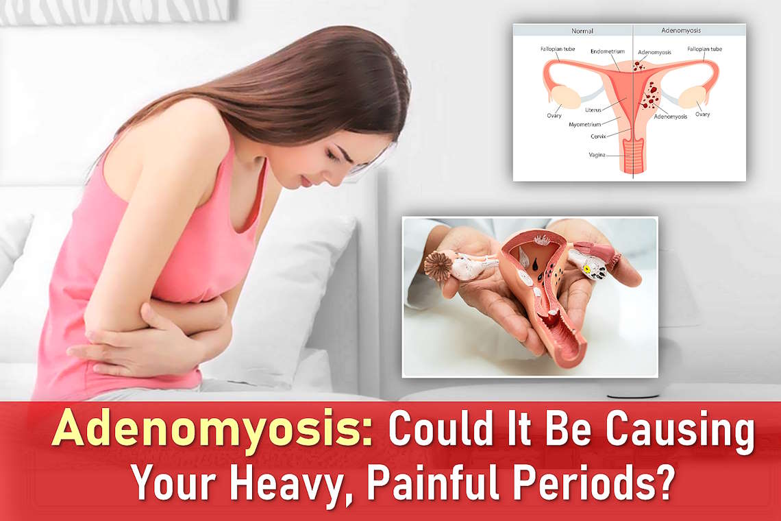 adenomyosis symptoms, real adenomyosis pictures, adenomyosis vs endometriosis pain, adenomyosis cause painful periods