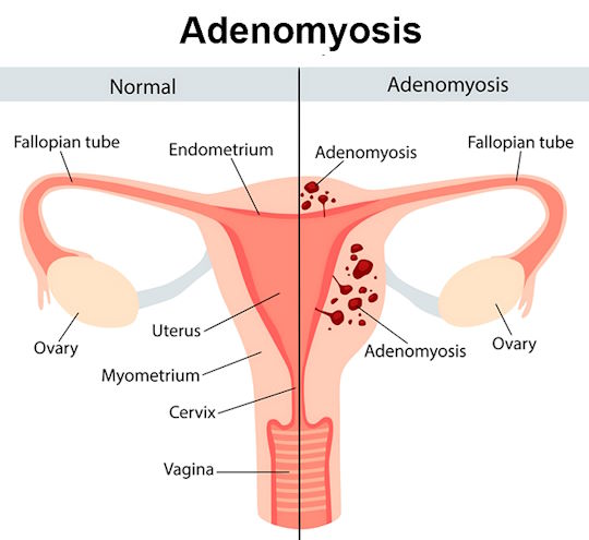 adenomyosis symptoms, what is adenomyosis, uterine adenomyosis