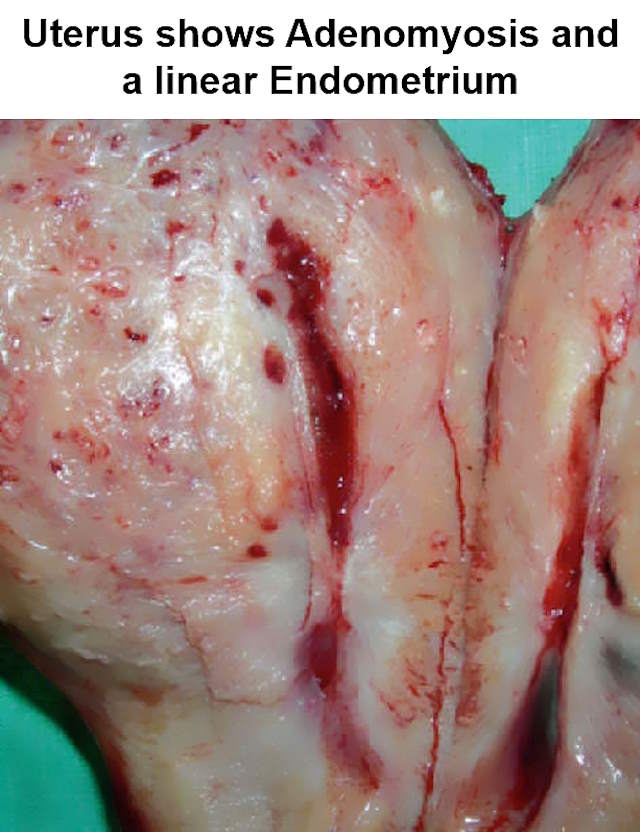 what is adenomyosis, uterine adenomyosis, real adenomyosis pictures
