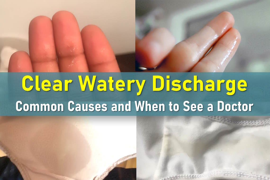 what does watery discharge mean, clear discharge, watery discharge before period, clear discharge before period, after sex
